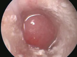 video-otoscopia