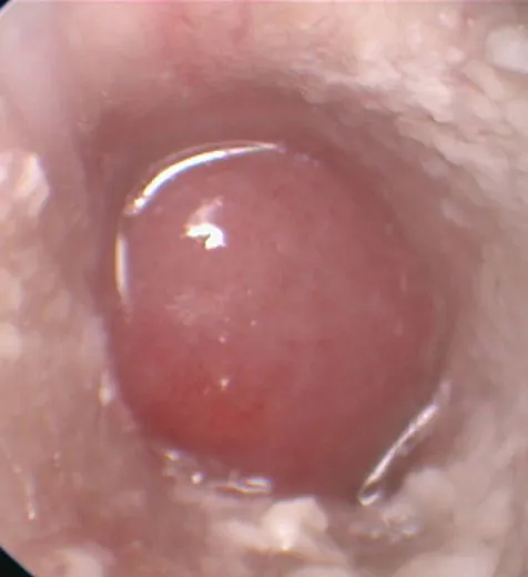 video-otoscopia